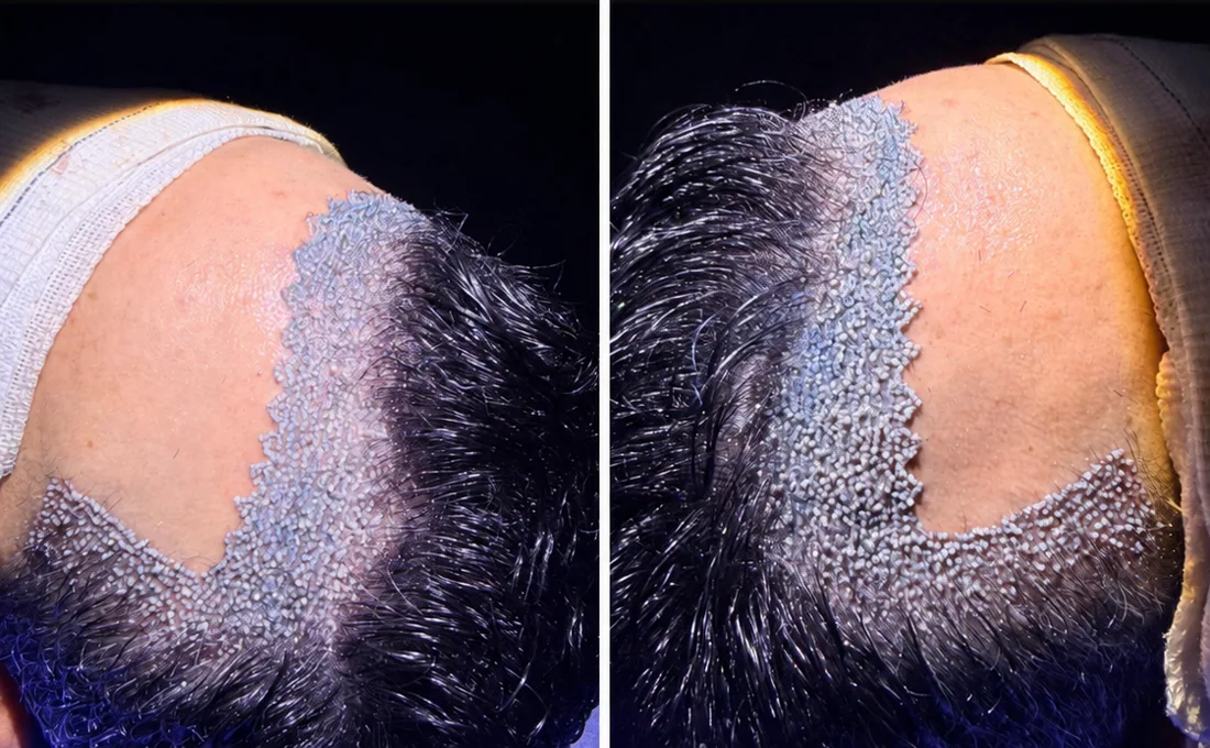 No Shave FUE: transplante realizado sem raspar o cabelo